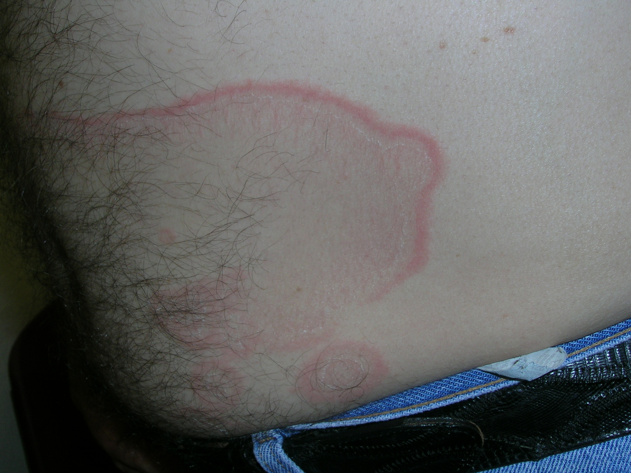 erythema annulare centrifugum