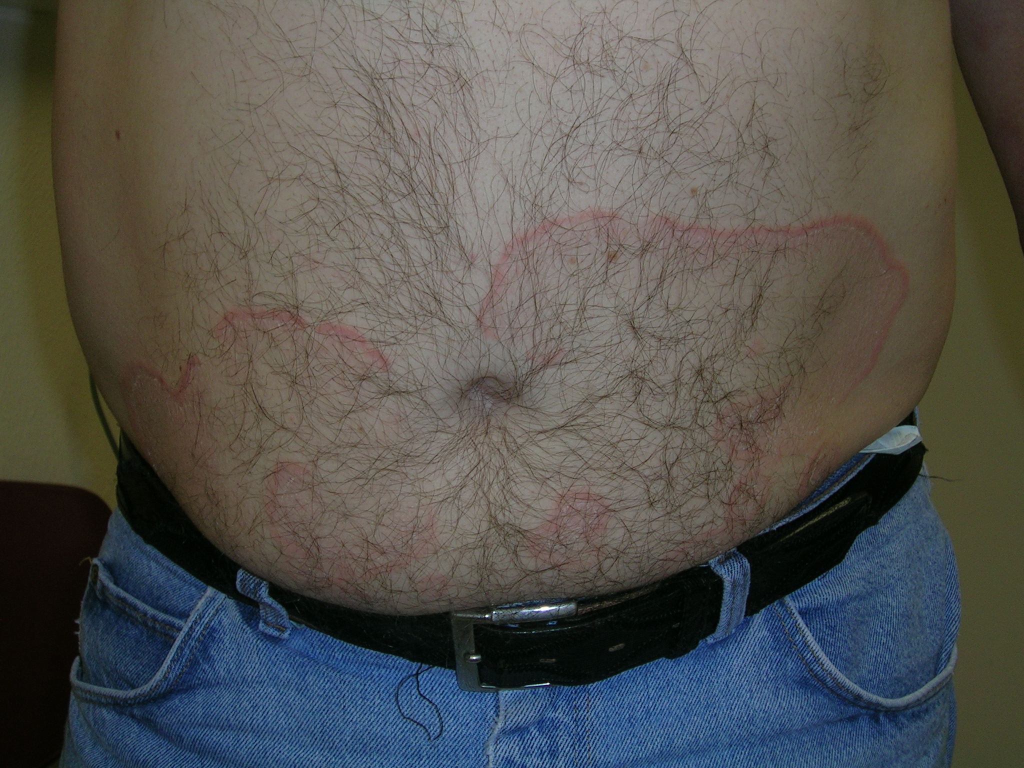 erythema annulare centrifugum