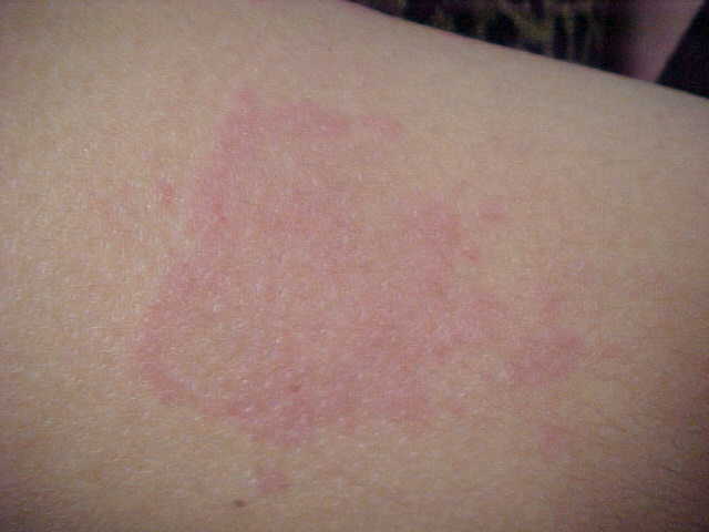 erythema annulare centrifugum