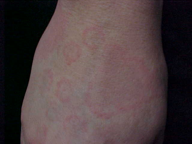 erythema annulare centrifugum