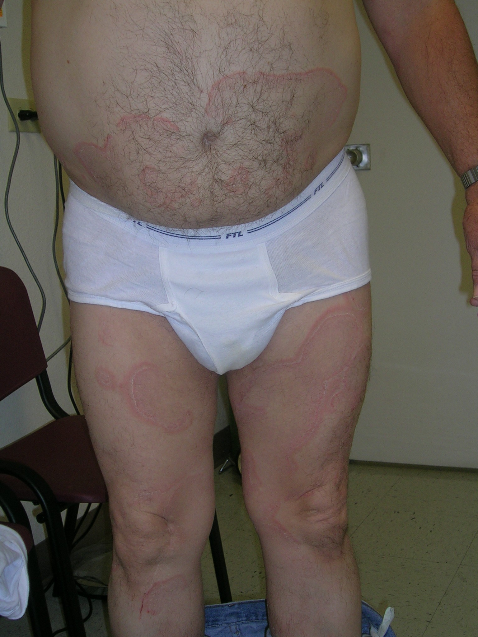 erythema annulare centrifugum