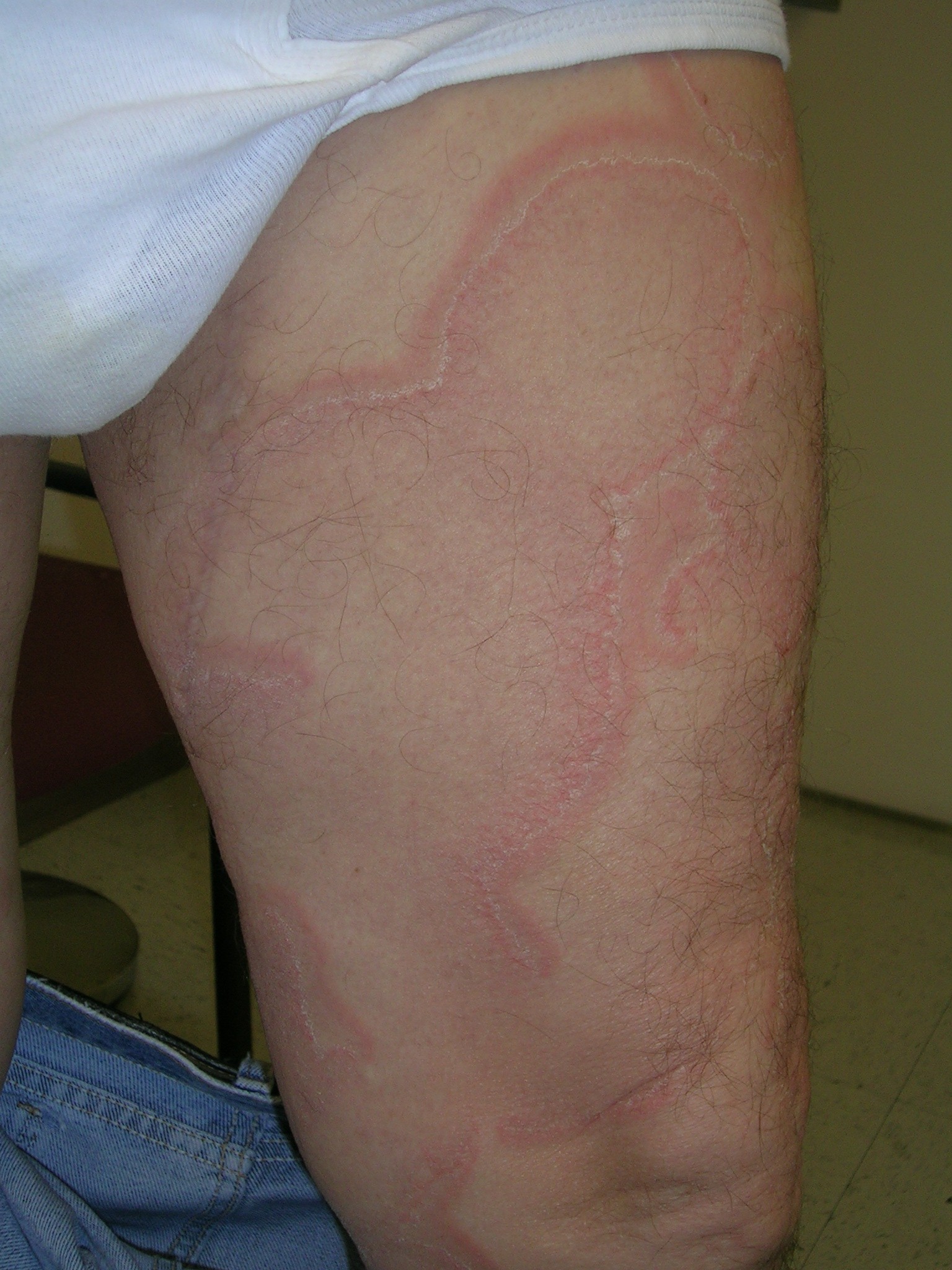 erythema annulare centrifugum