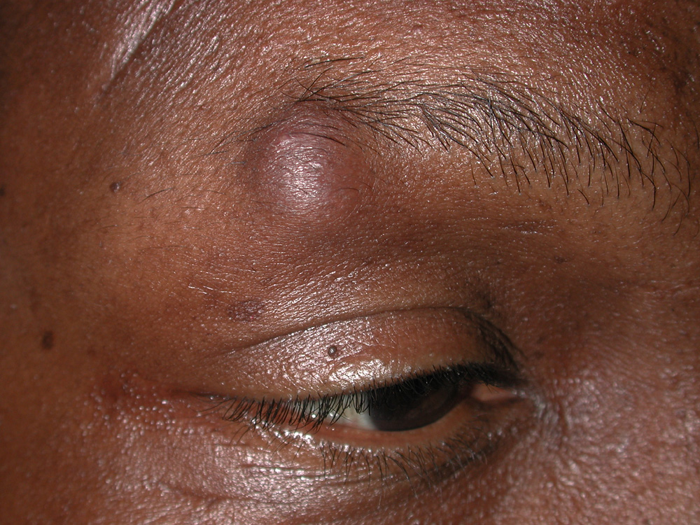 cyst, epidermal