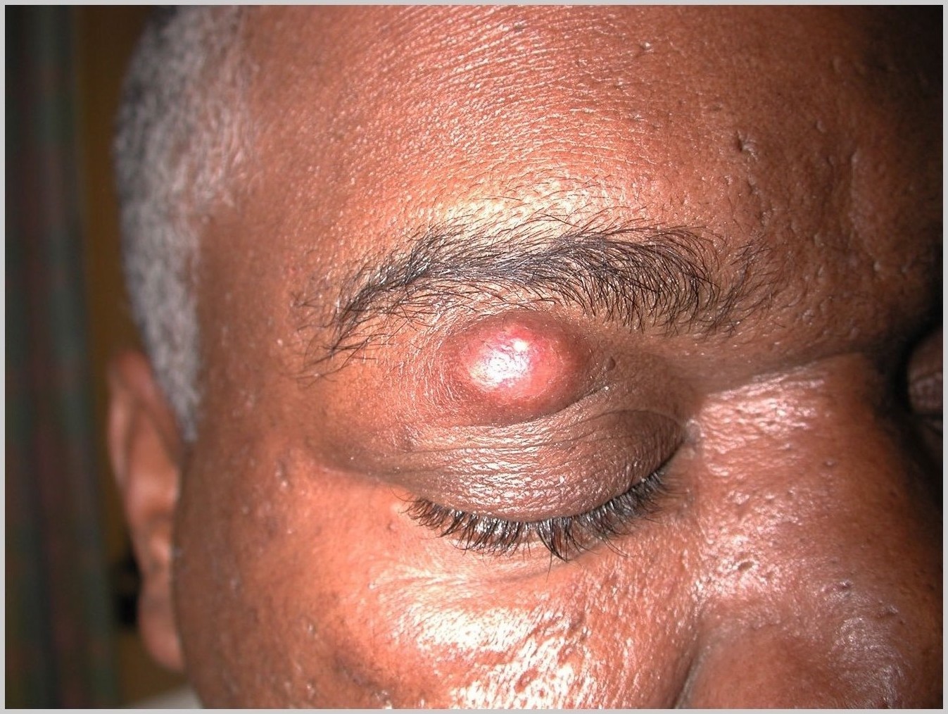 cyst, epidermal