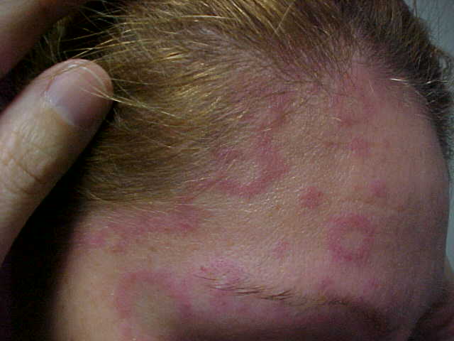 erythema annulare centrifugum