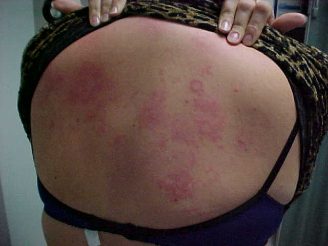 erythema annulare centrifugum