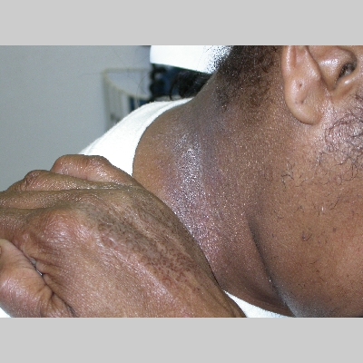 contact dermatitis, irritant