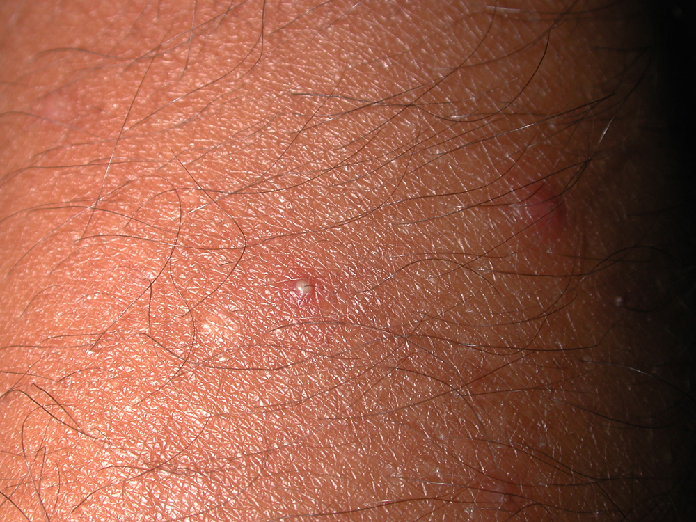 folliculitis