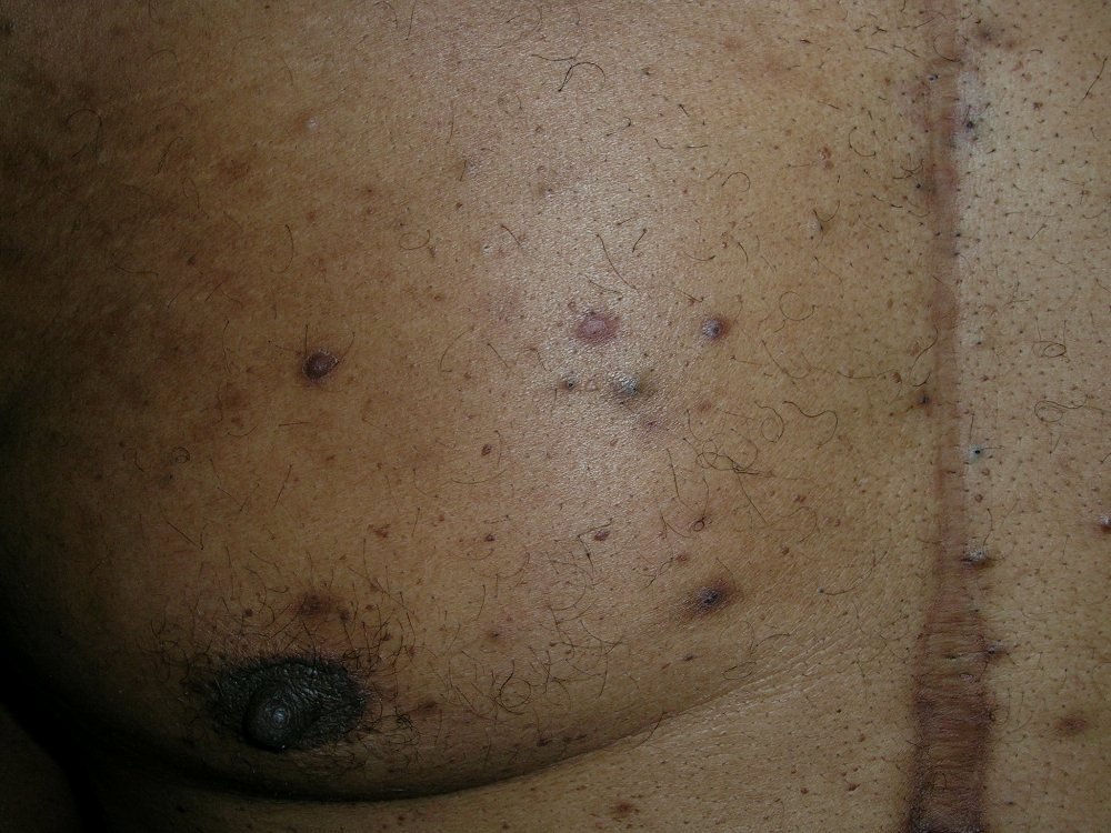 folliculitis