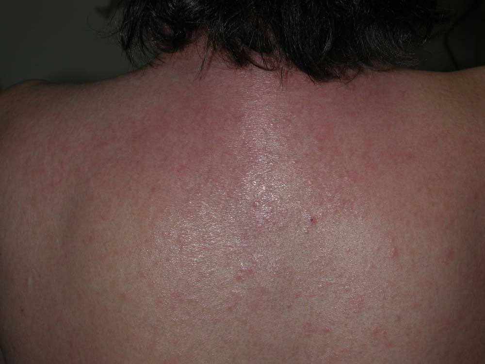 atopic dermatitis