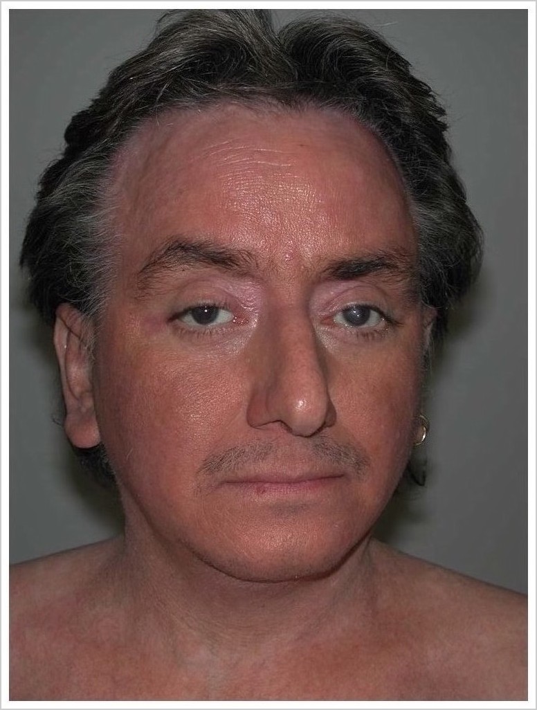 atopic dermatitis