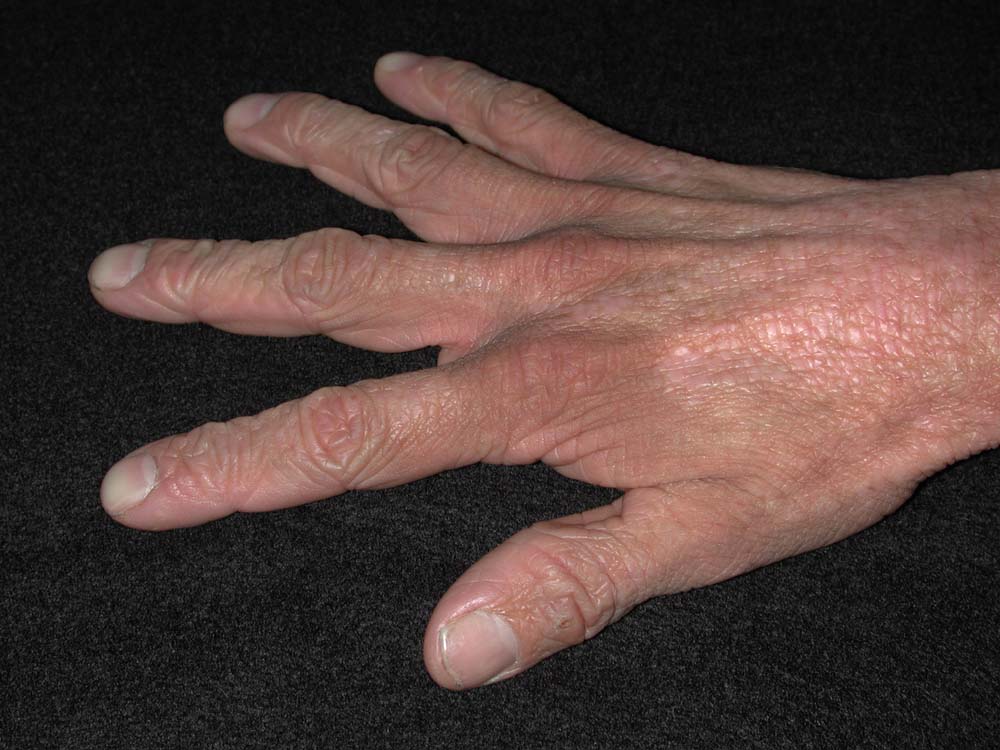 atopic dermatitis