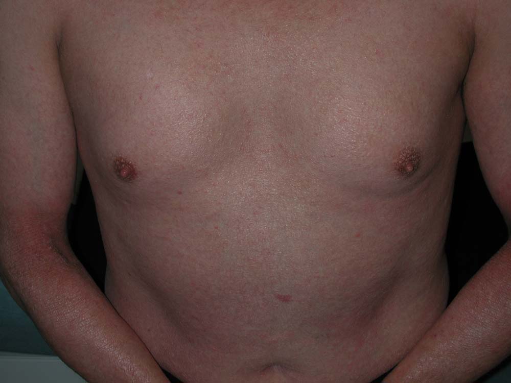 atopic dermatitis
