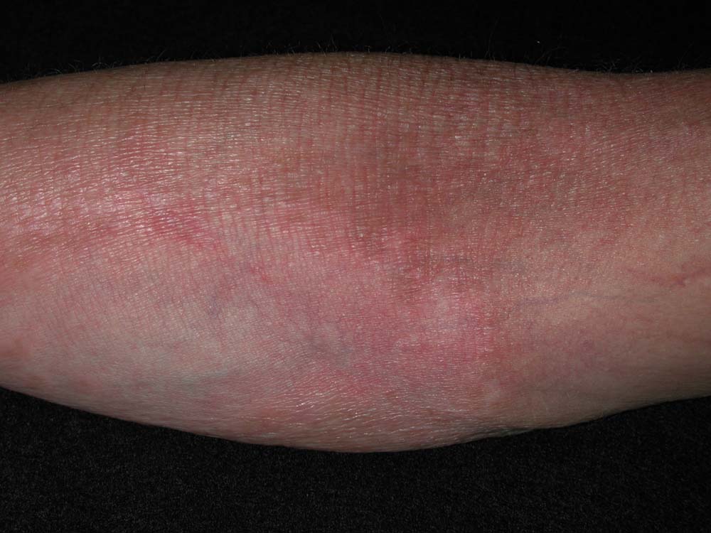 atopic dermatitis