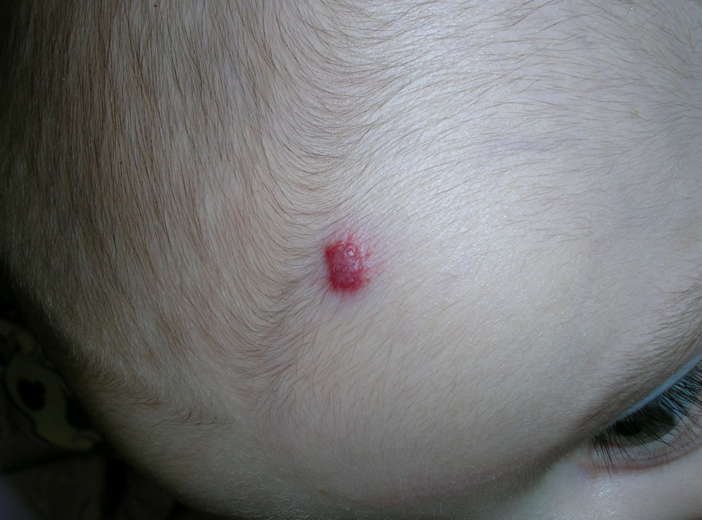 hemangioma, strawberry