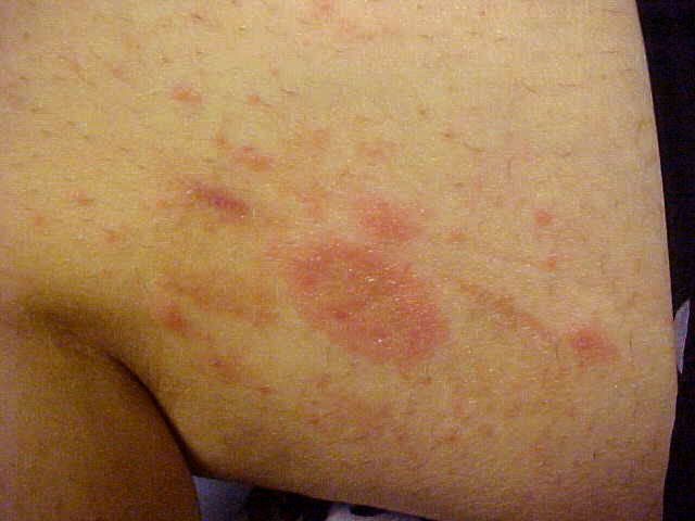 pityriasis rosea