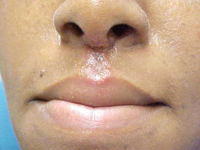 herpes simplex type I