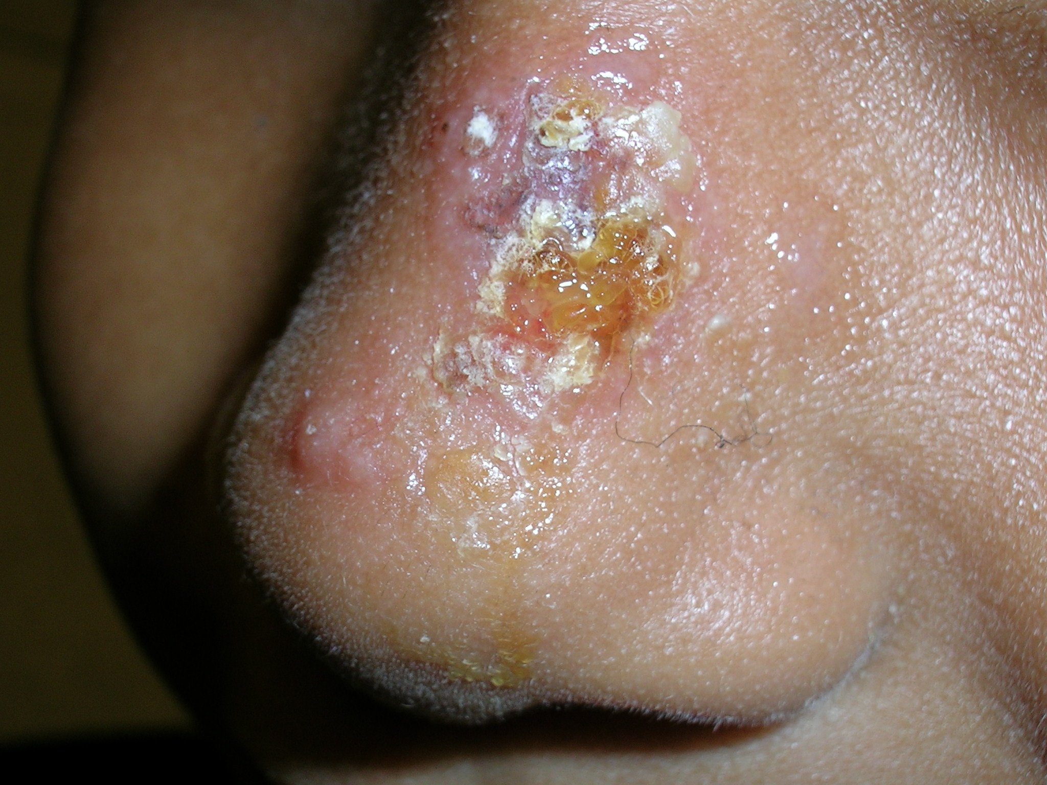 impetigo