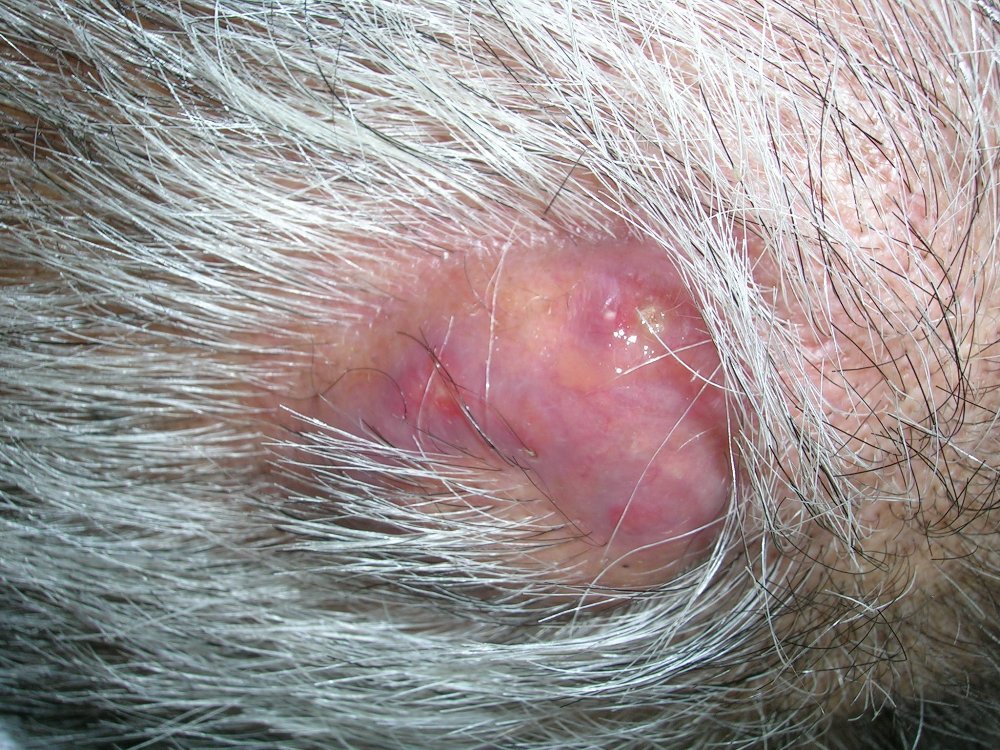 cyst, epidermal