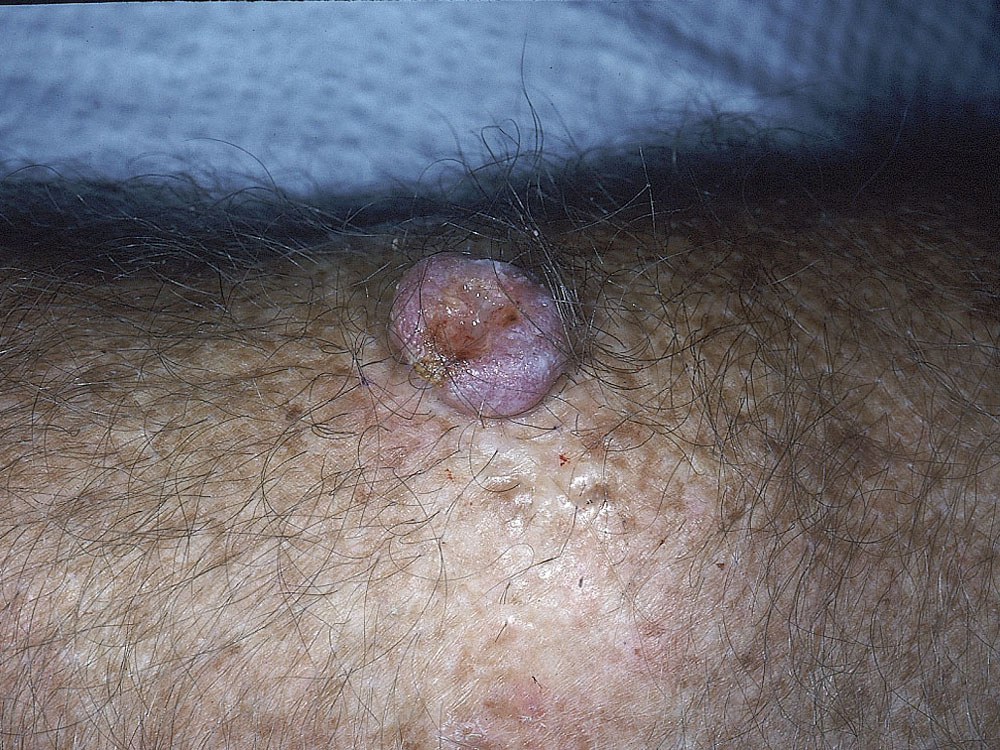 keratoacanthoma