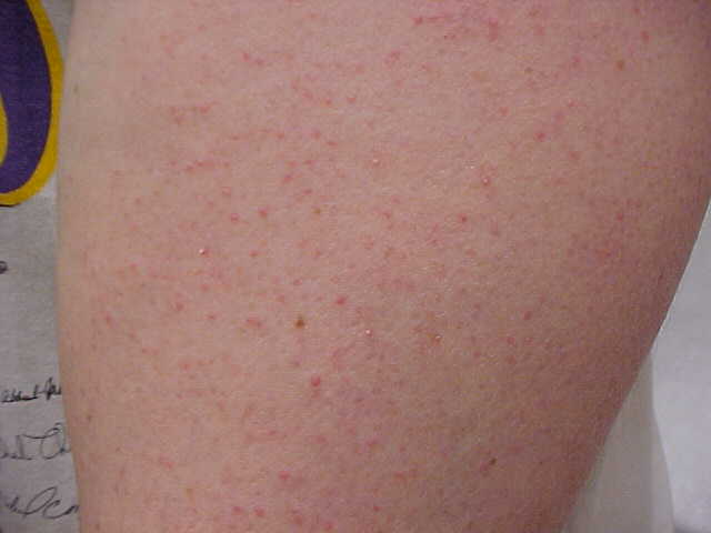 keratosis pilaris