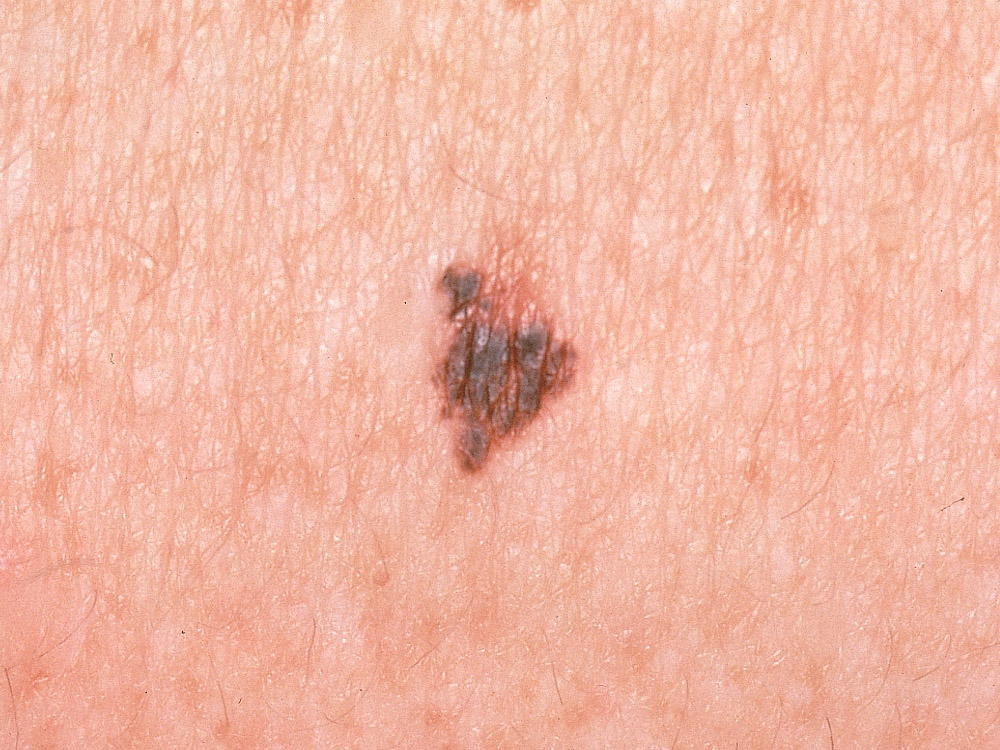 melanoma, superficial spreading