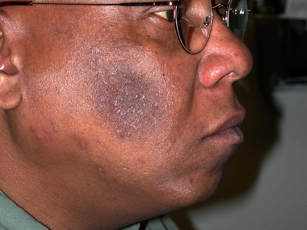 melasma