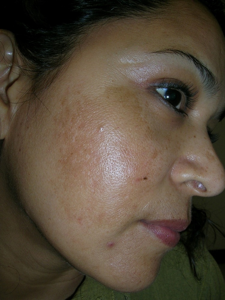 melasma