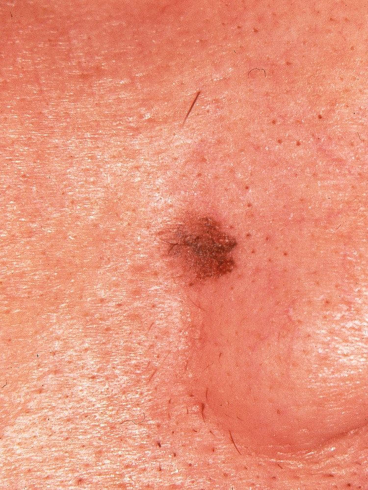 melanoma, superficial spreading