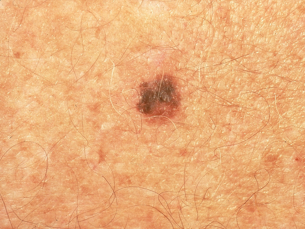 melanoma, superficial spreading