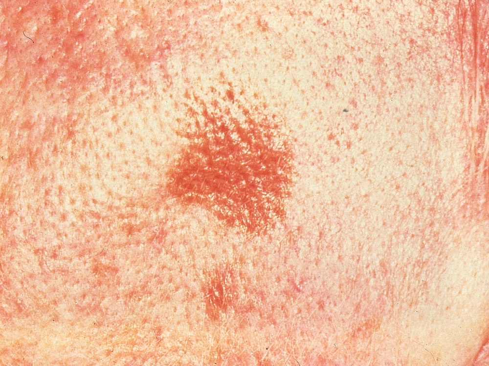 melanoma, superficial spreading