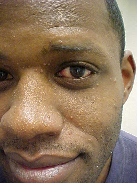 molluscum contagiosum