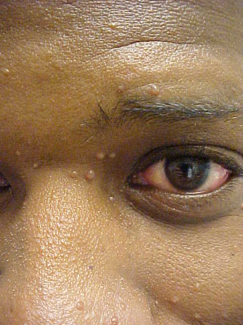 molluscum contagiosum