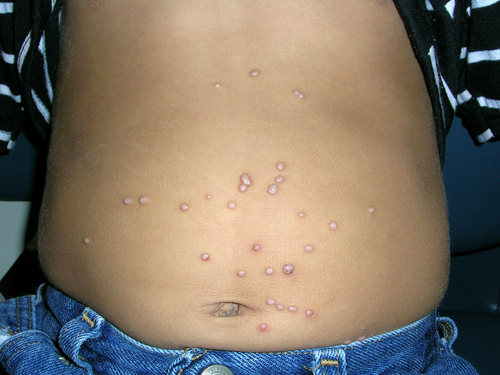 molluscum contagiosum