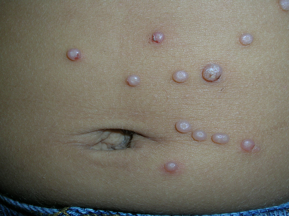molluscum contagiosum