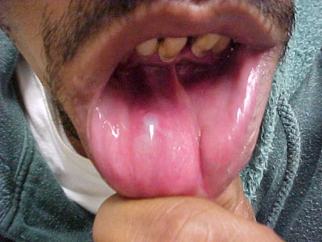 mucocele