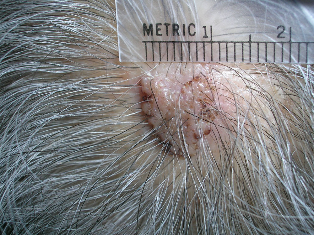 nevus, dermal