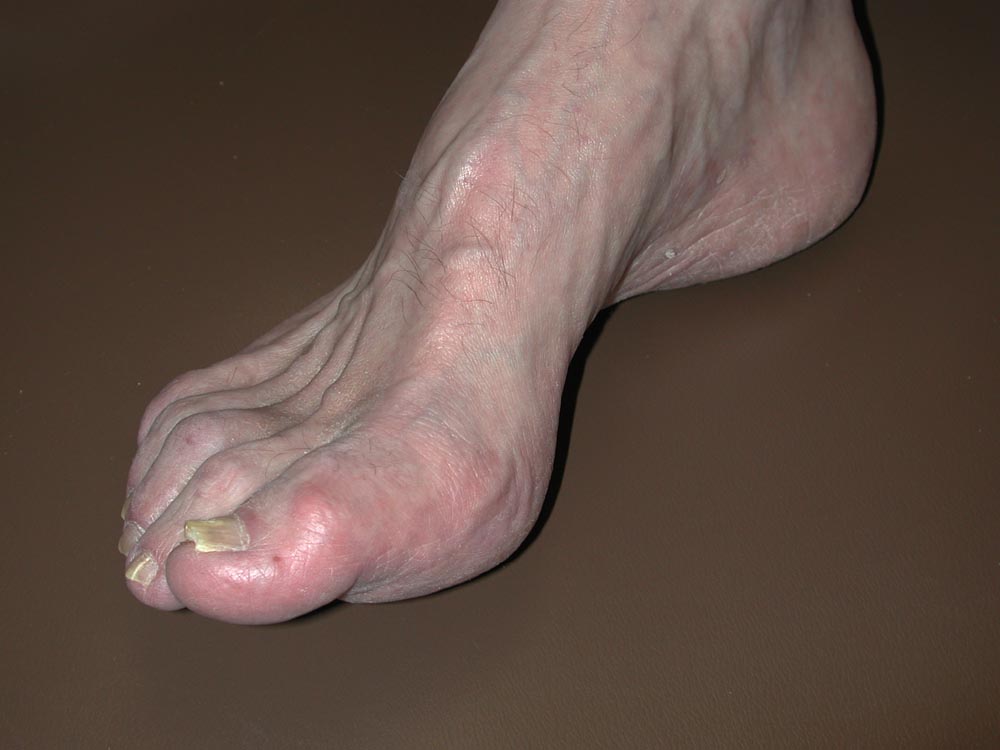 onychomycosis