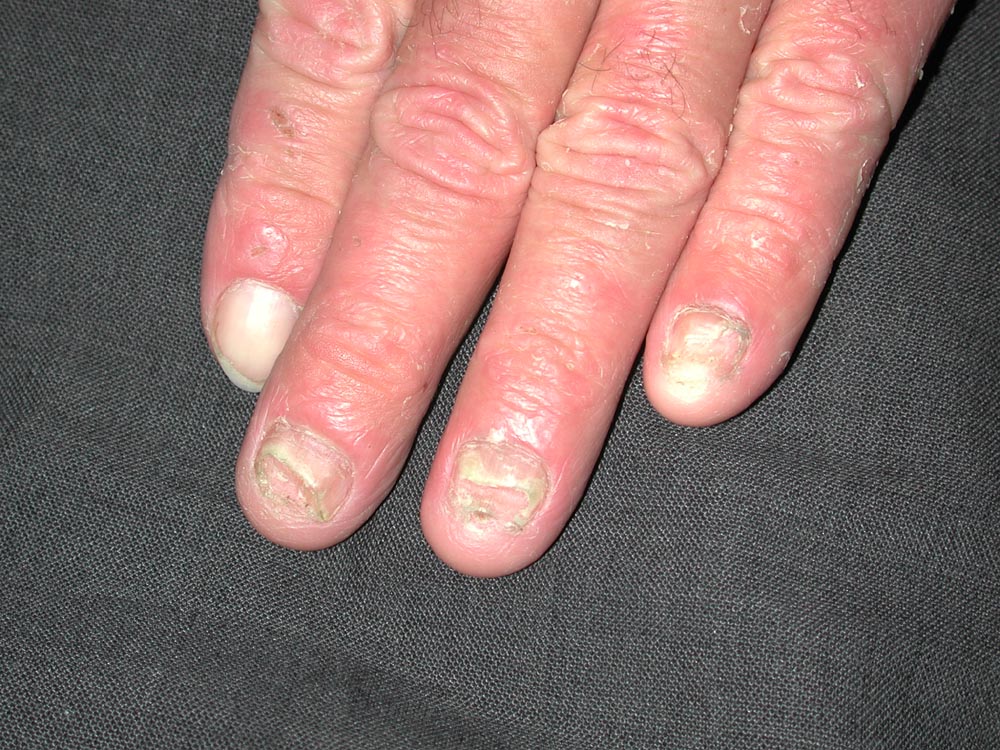 onychomycosis