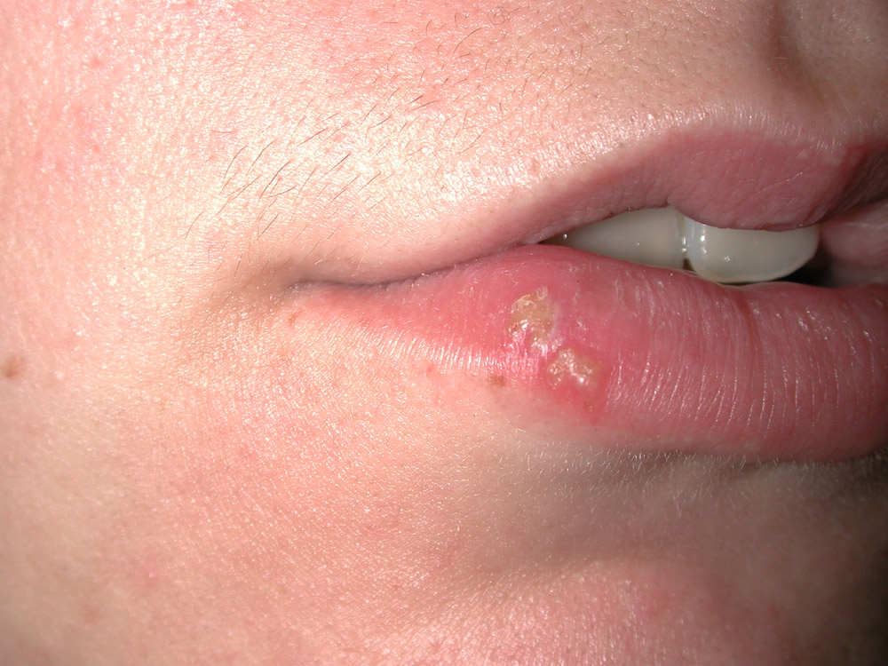 herpes simplex type I