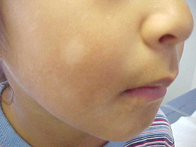 pityriasis alba