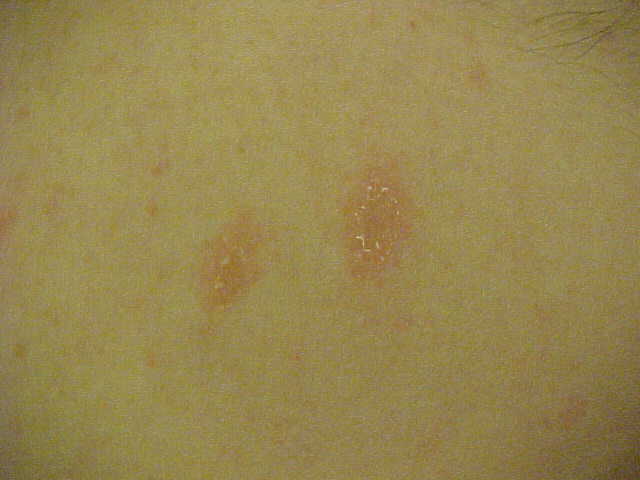 pityriasis rosea
