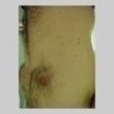 pityriasis rosea