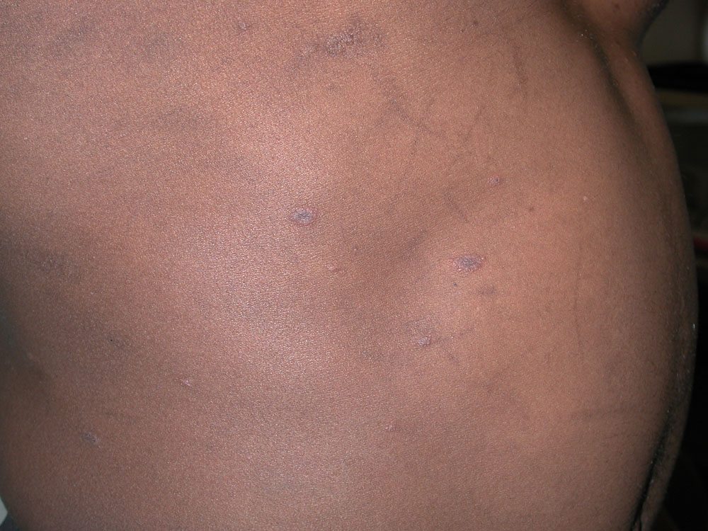 pityriasis rosea