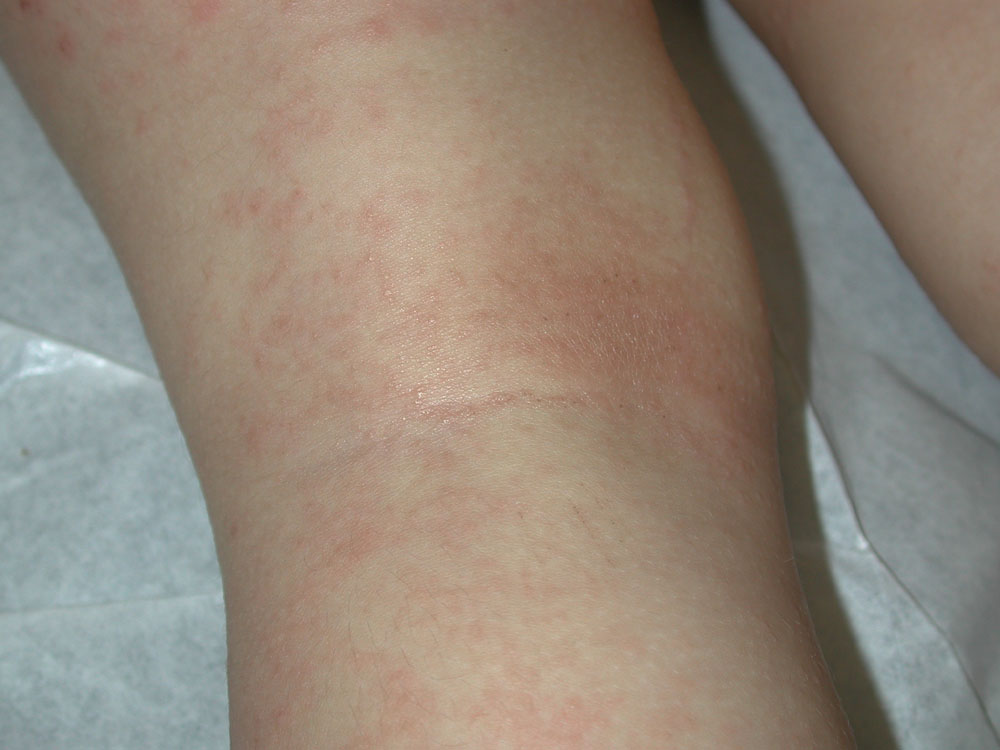 atopic dermatitis