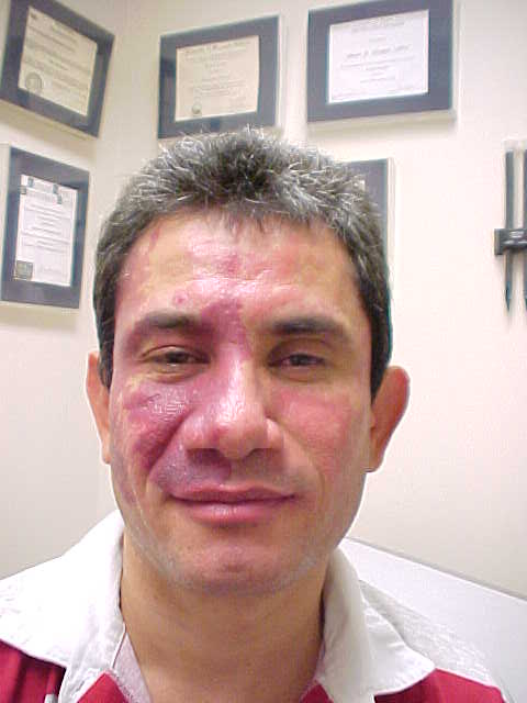 hemangioma, strawberry