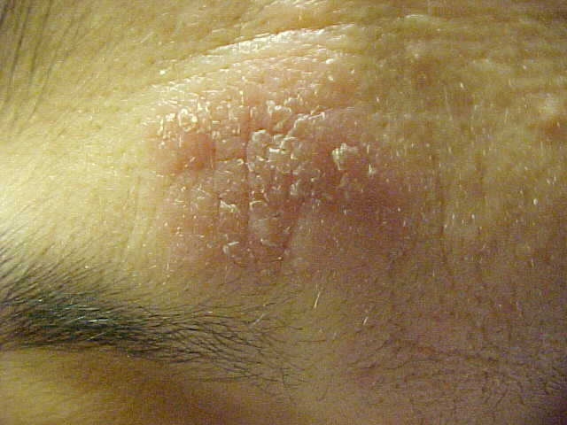 psoriasis