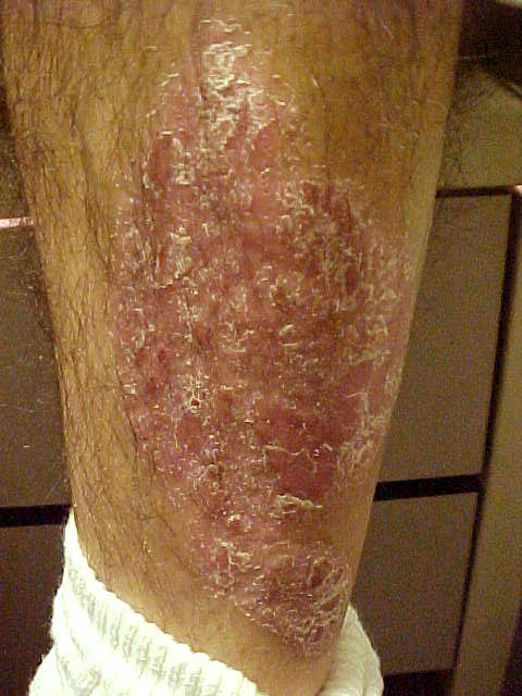 psoriasis