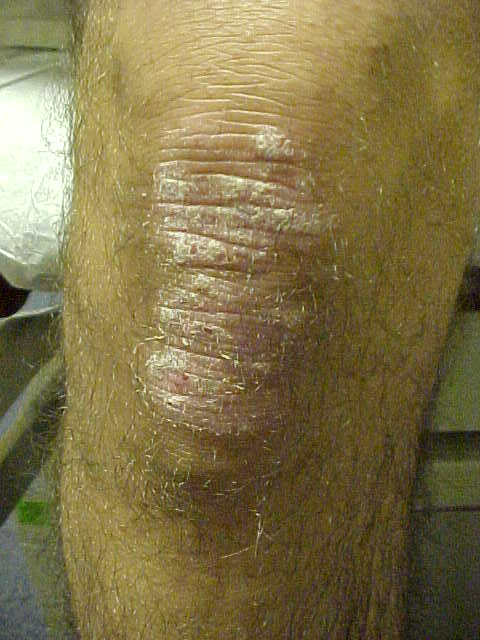 psoriasis