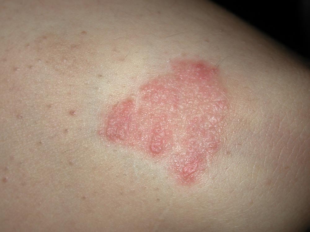 psoriasis